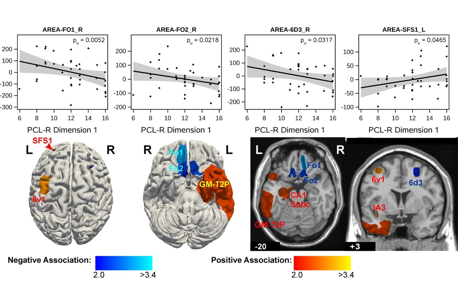 ¿Qué se oculta en el cerebro de los psicópatas? Un estudio revela una anomalía común