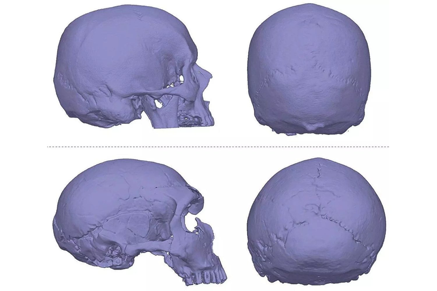 Un eco en el cráneo: pistas neandertales tras una malformación cerebral moderna