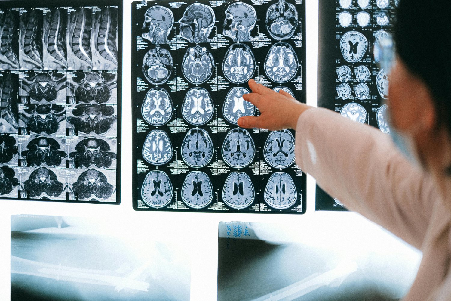 El cerebro revela lo que la mente oculta: la sorprendente marca invisible de la psicopatía