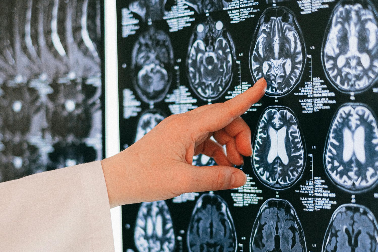 Las Diferencias En El Cerebro De Los Psicopatas