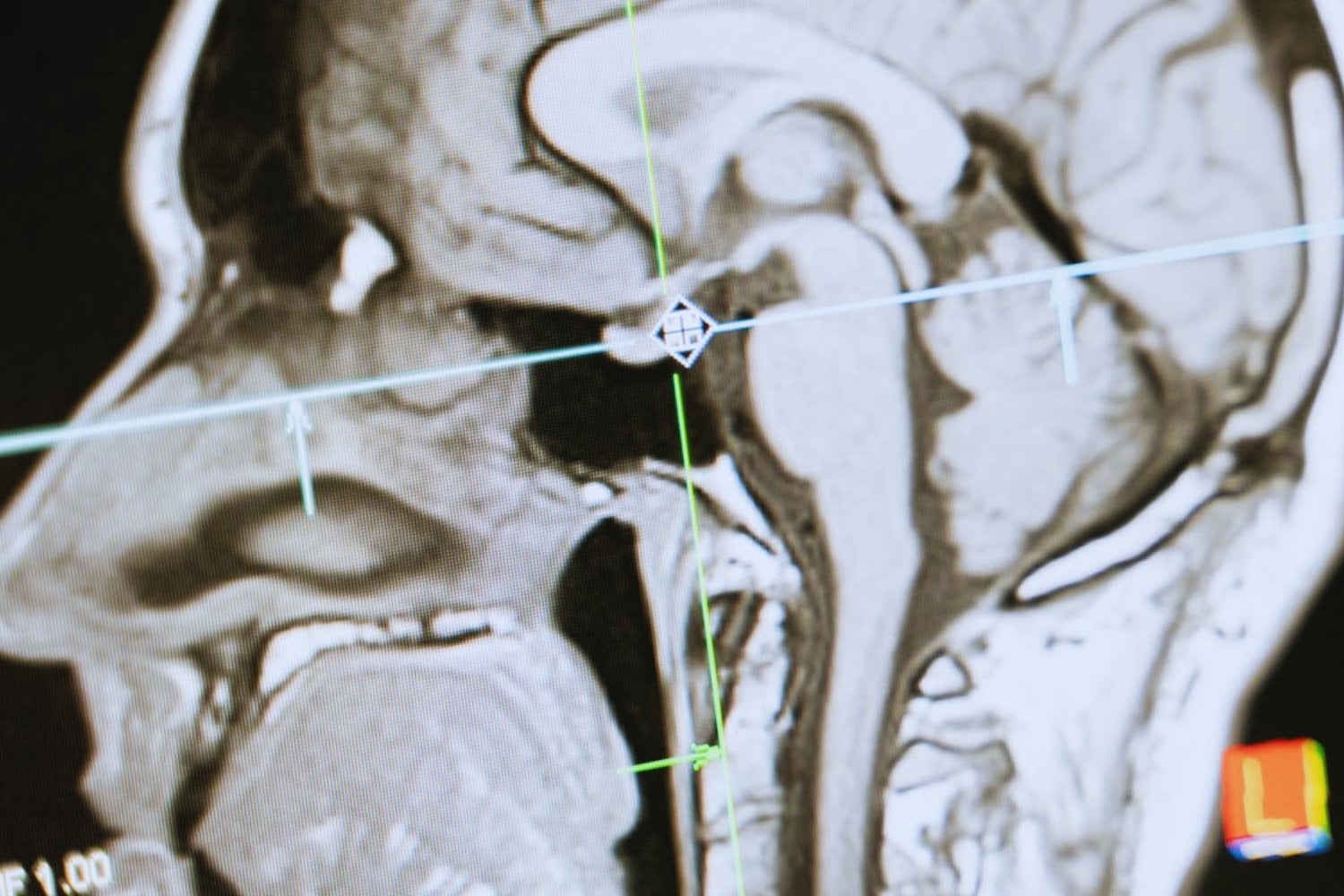 El delicado arte del cerebro para silenciar los recuerdos de miedo
