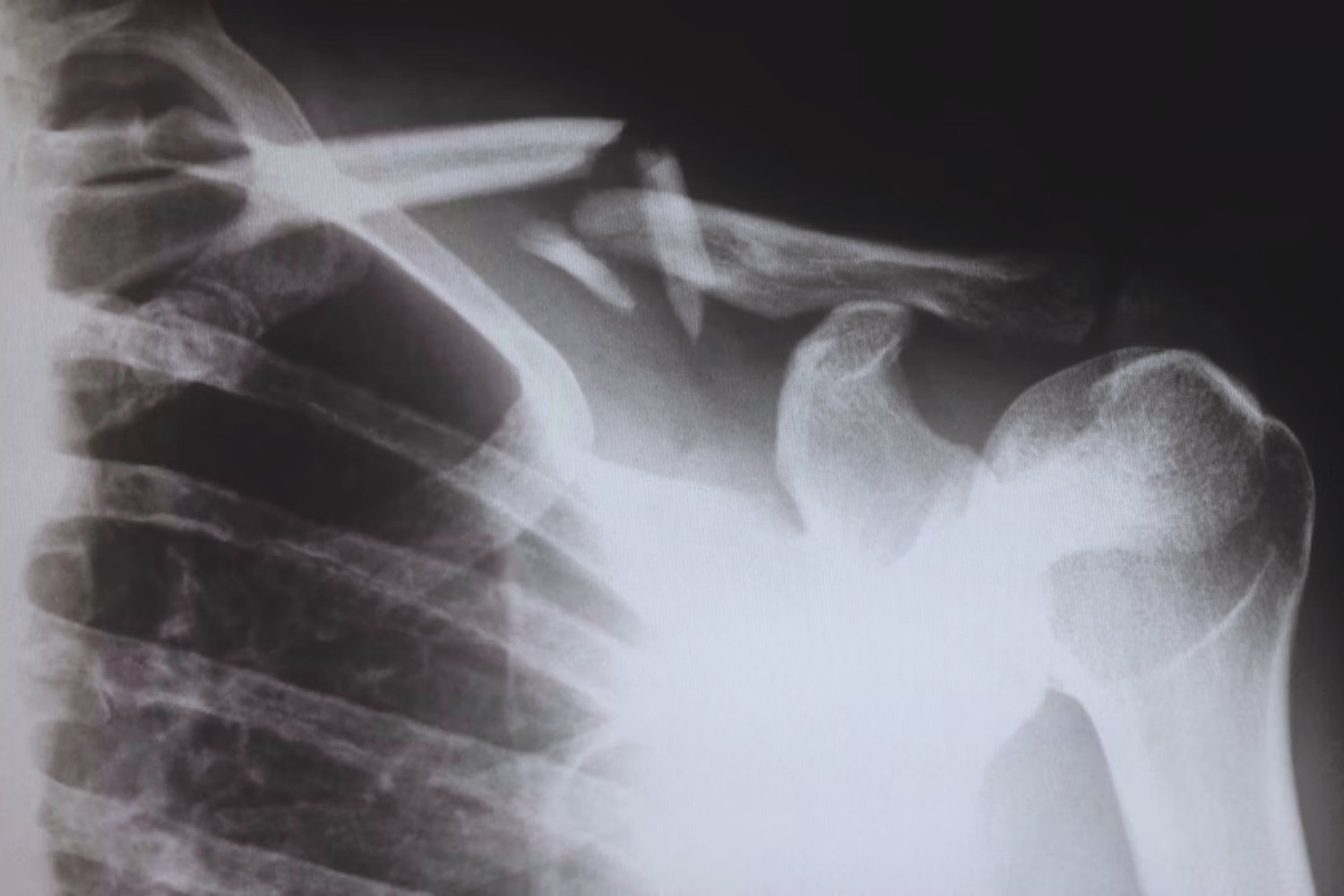 El secreto oculto en los músculos que podría cambiar la forma de reparar huesos