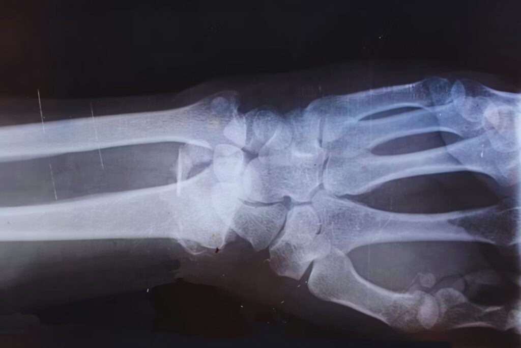 El secreto oculto en los músculos que podría cambiar la forma de reparar huesos
