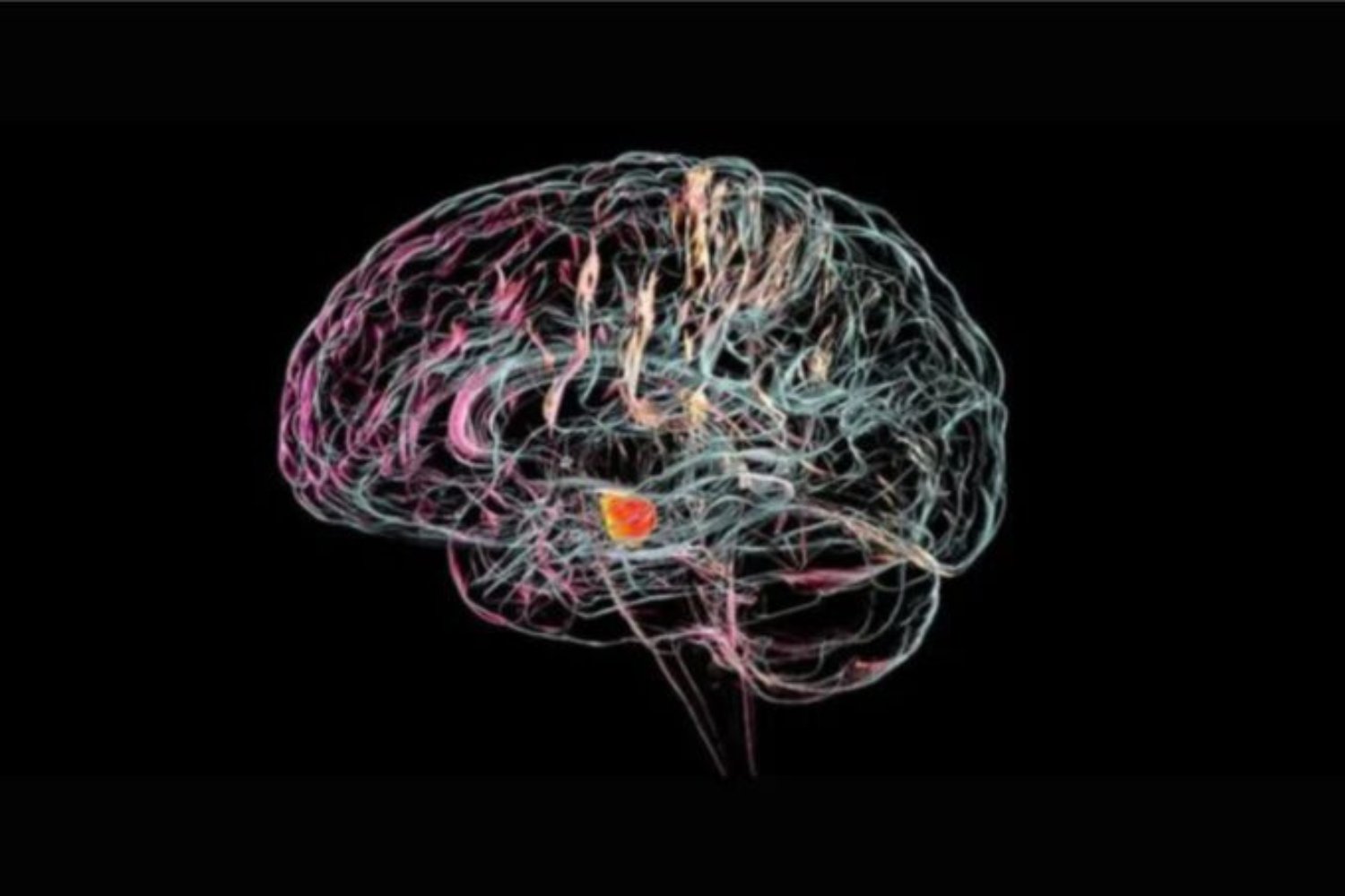 El marcapasos cerebral que devolvió la alegría tras décadas de depresión