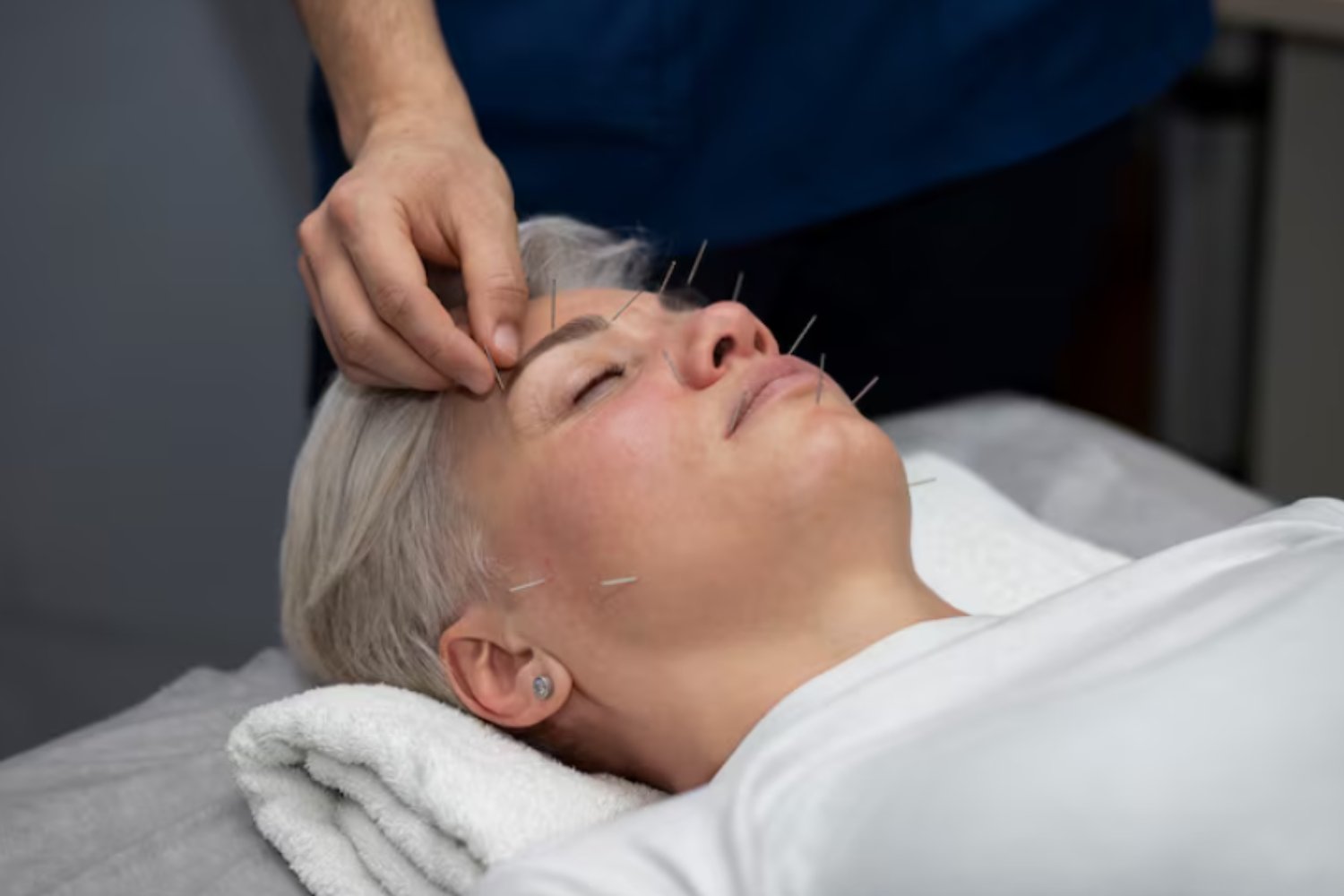 ¿Es la acupuntura estética el nuevo bótox? El tratamiento natural que conquista a la Generación Z)