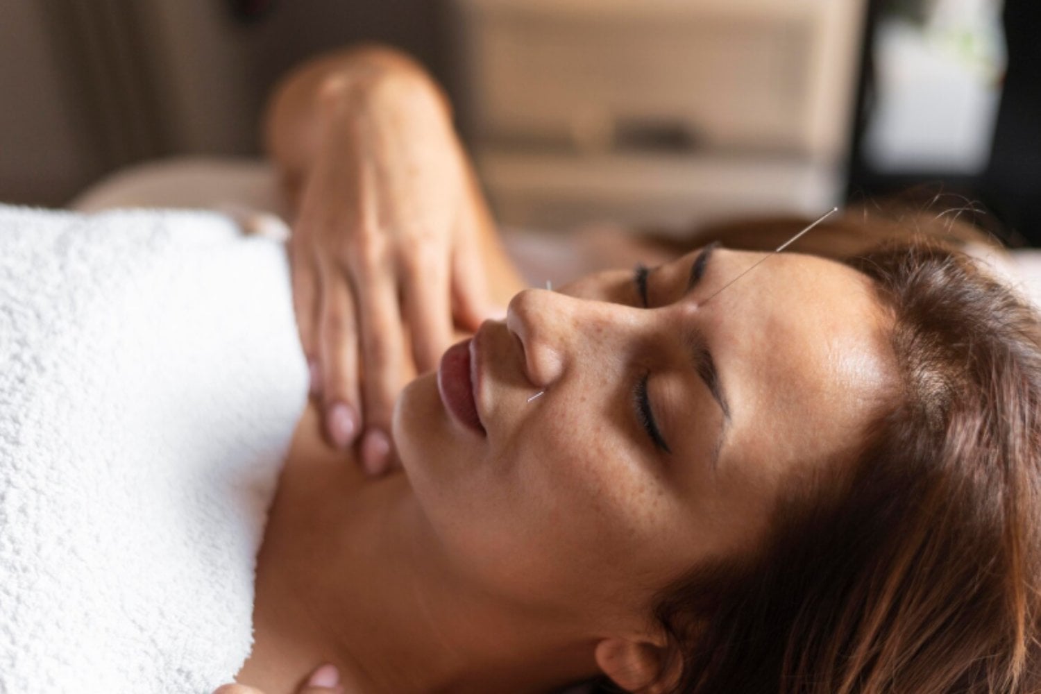 ¿Es la acupuntura estética el nuevo bótox? El tratamiento natural que conquista a la Generación Z)