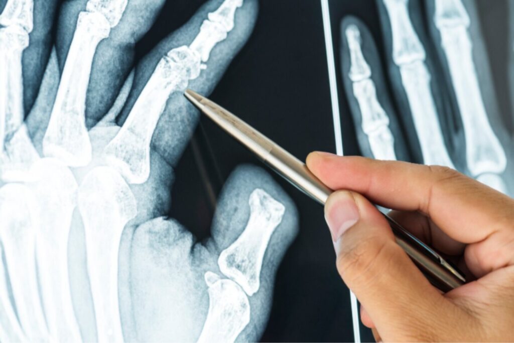 Saltarse el desayuno aumenta el riesgo de fracturas óseas, según la ciencia