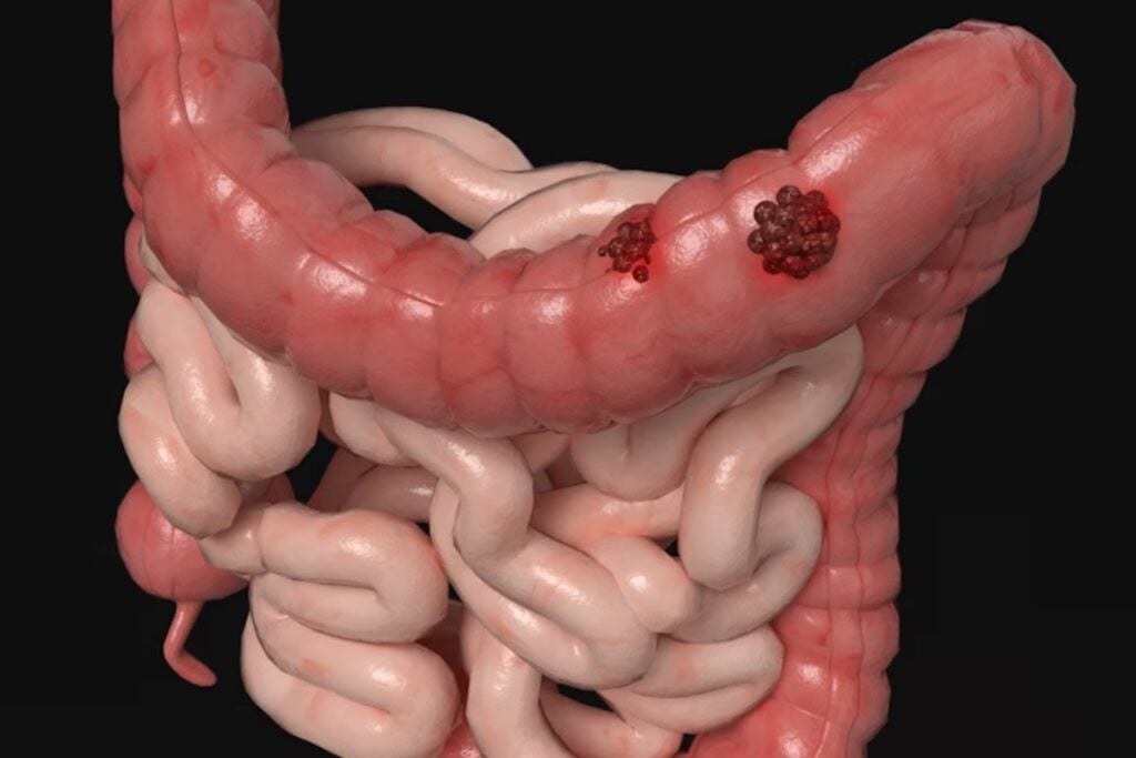 Un fármaco inesperado se suma a la lucha contra el cáncer de colon en Argentina. Frenar la metástasis ya no es solo una esperanza