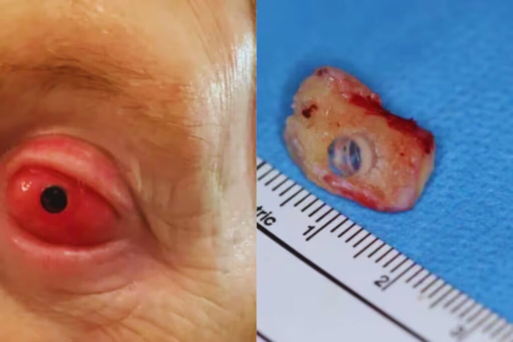 Un diente para devolver la luz. La cirugía que parecía ciencia ficción y cambió una vida en Canadá