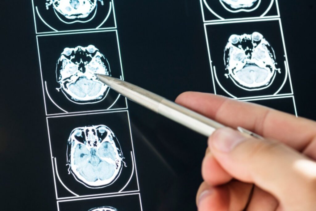 La “autopista” de los tumores: la técnica que bloquea el avance del glioblastoma