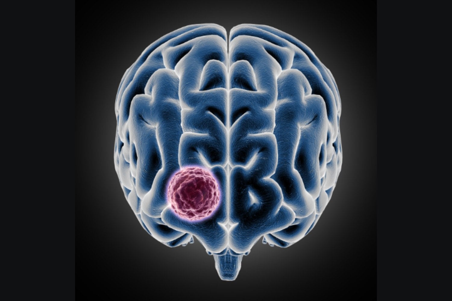 La “autopista” de los tumores: la técnica que bloquea el avance del glioblastoma