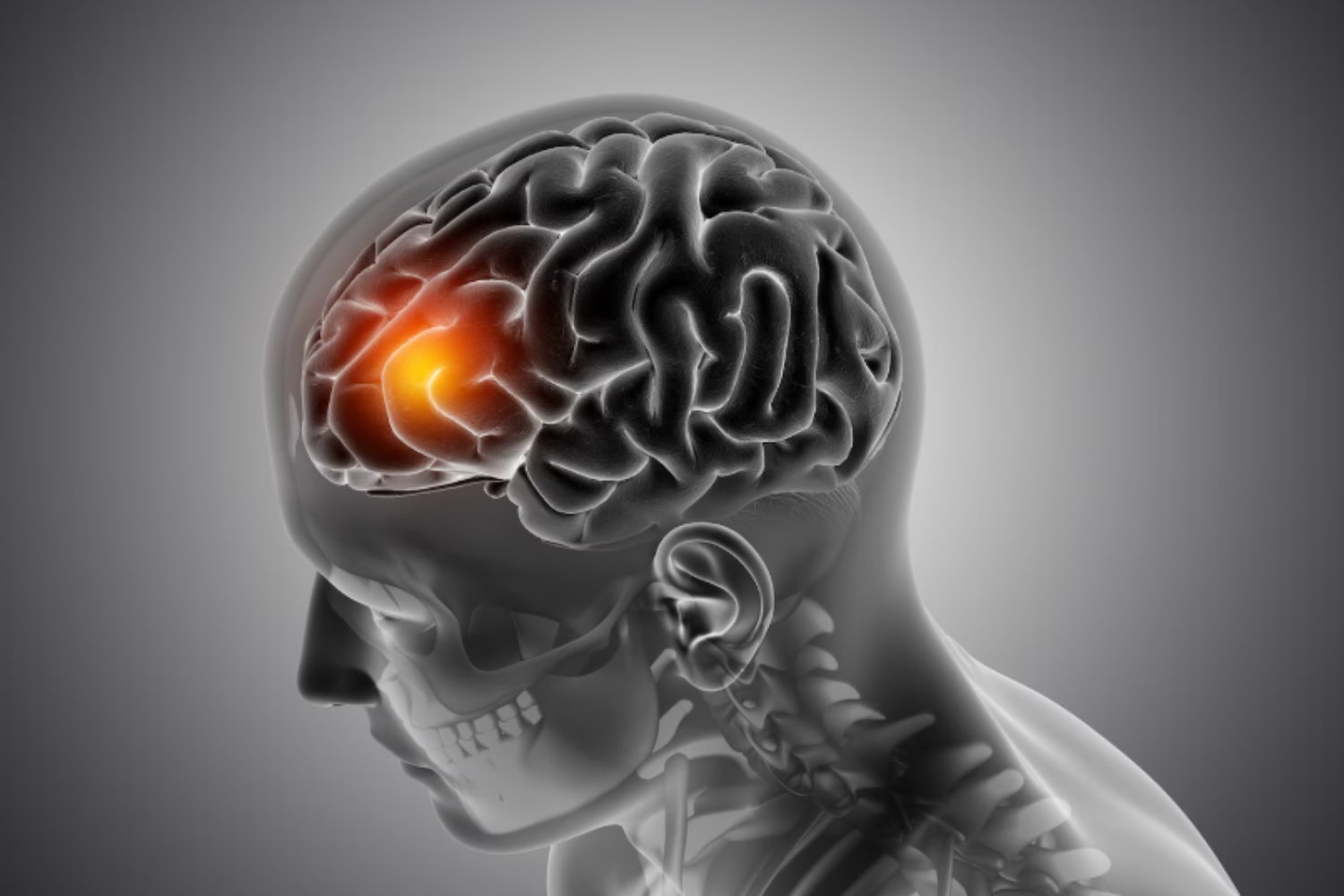 La “autopista” de los tumores: la técnica que bloquea el avance del glioblastoma