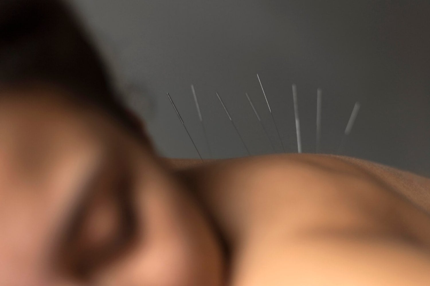 Acupuntura y dolor lumbar crónico: la terapia ancestral que gana espacio en la medicina moderna