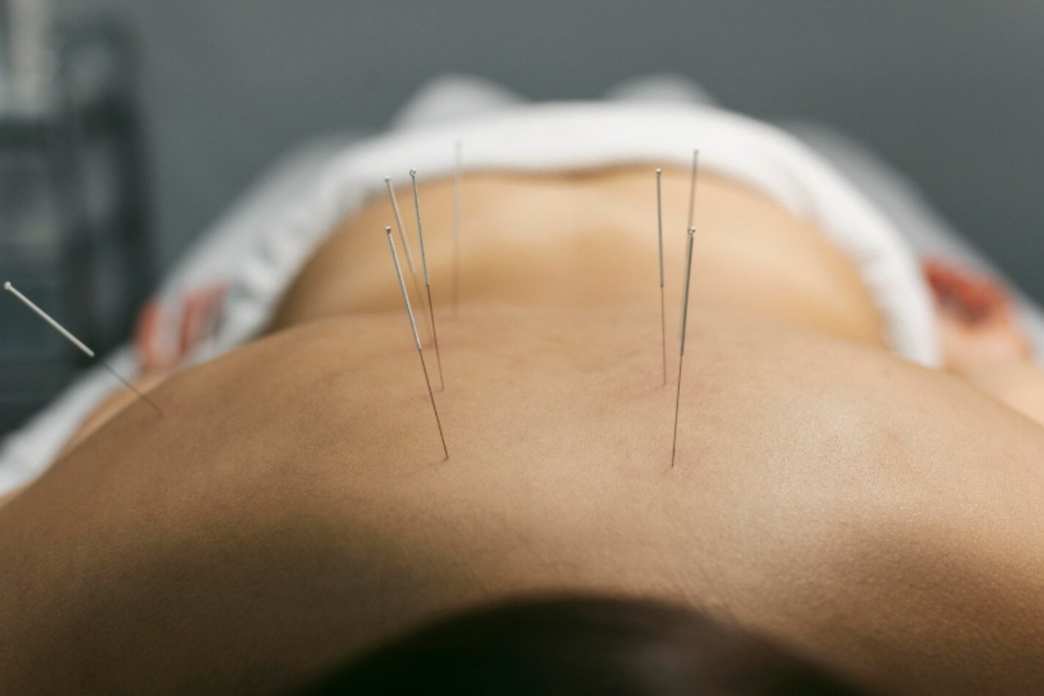 Acupuntura y dolor lumbar crónico: la terapia ancestral que gana espacio en la medicina moderna