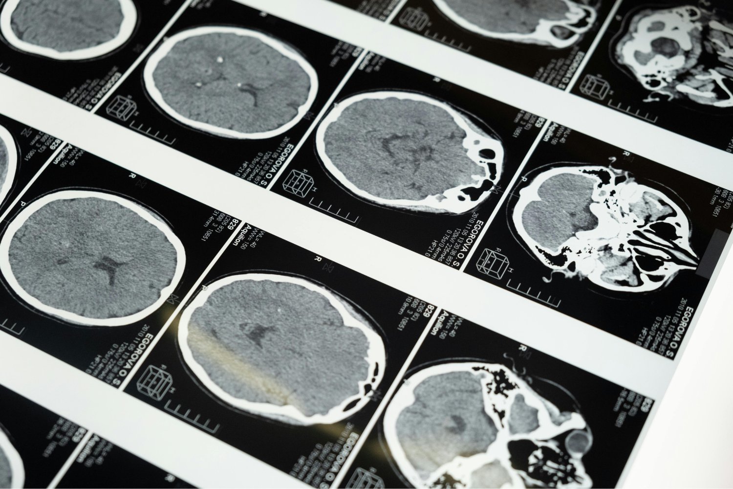 Mini cerebros en el laboratorio: la nueva esperanza para diferenciar esquizofrenia de trastorno bipolar