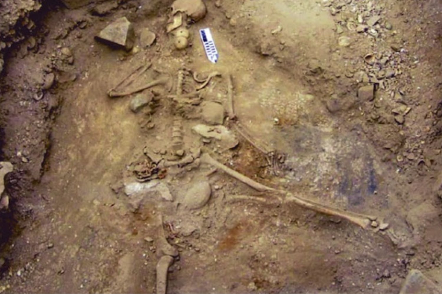 El niño del pasado que enfermó sin explicación: la rara patología descubierta en huesos bizantinos de Turquía