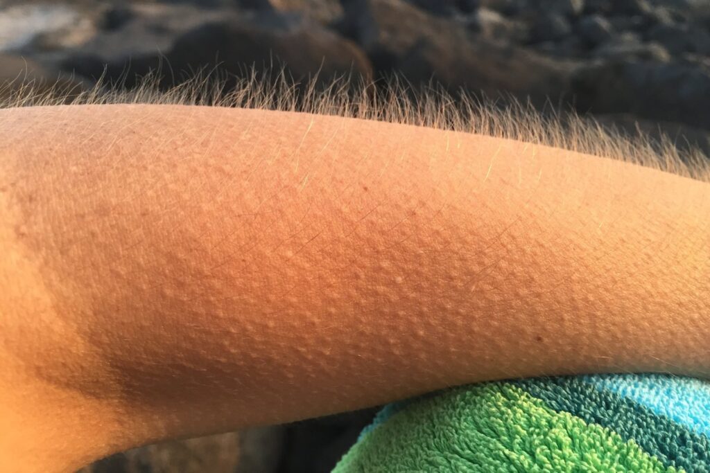 Por qué se nos eriza la piel al escuchar música o sentir miedo: la ciencia detrás de la “piel de gallina”