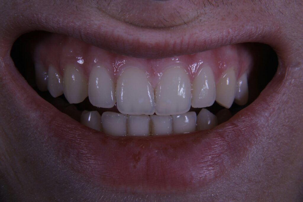 Cultivar Dientes En Laboratorio