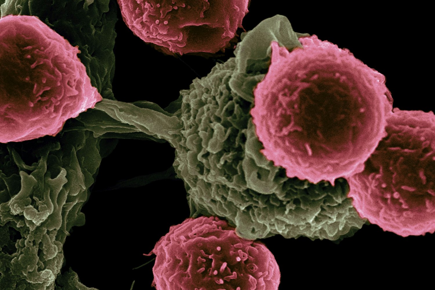 Tratamiento Fototermico Contra El Cancer