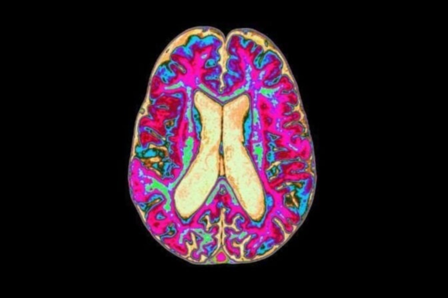 El mayor mapa del cerebro humano en desarrollo acaba de completarse. Y lo que revela podría explicar el origen del autismo y la esquizofrenia