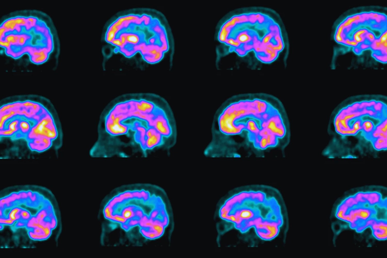 No se trata de personalidad ni de educación. Los científicos descubren que la timidez surge de una región del cerebro que hasta ahora nadie había relacionado con las emociones