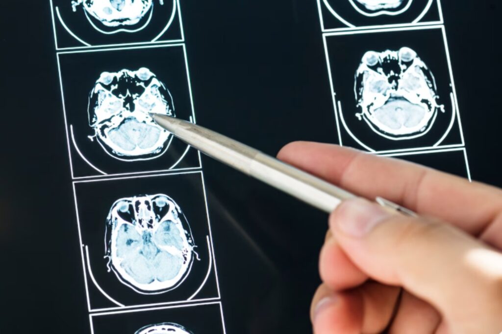 La hipertensión deja huellas en el cerebro antes de dar la cara: así lo revela un estudio que cambia lo que creíamos saber