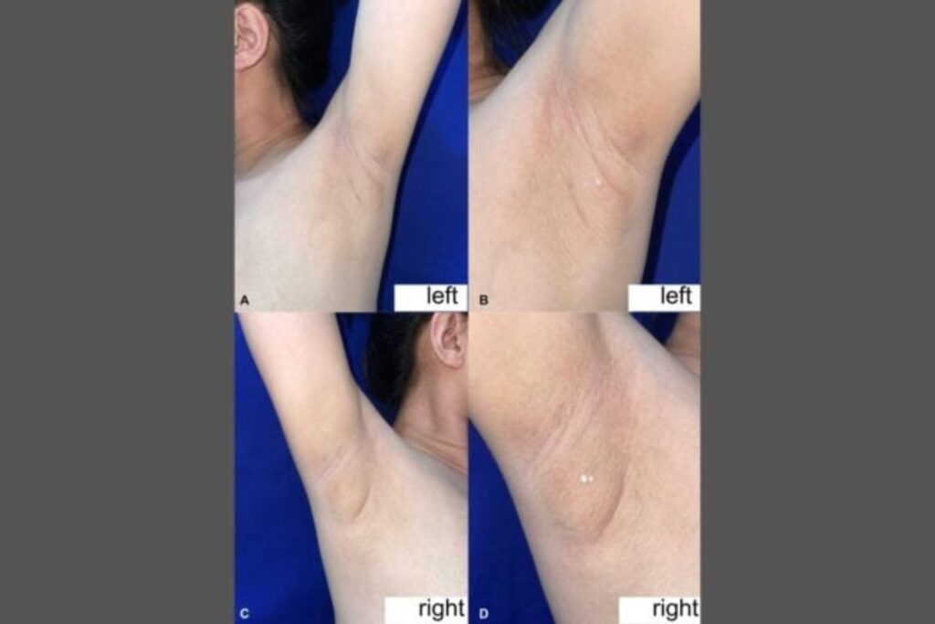 Mujer Que Suda Leche Por Las Axilas