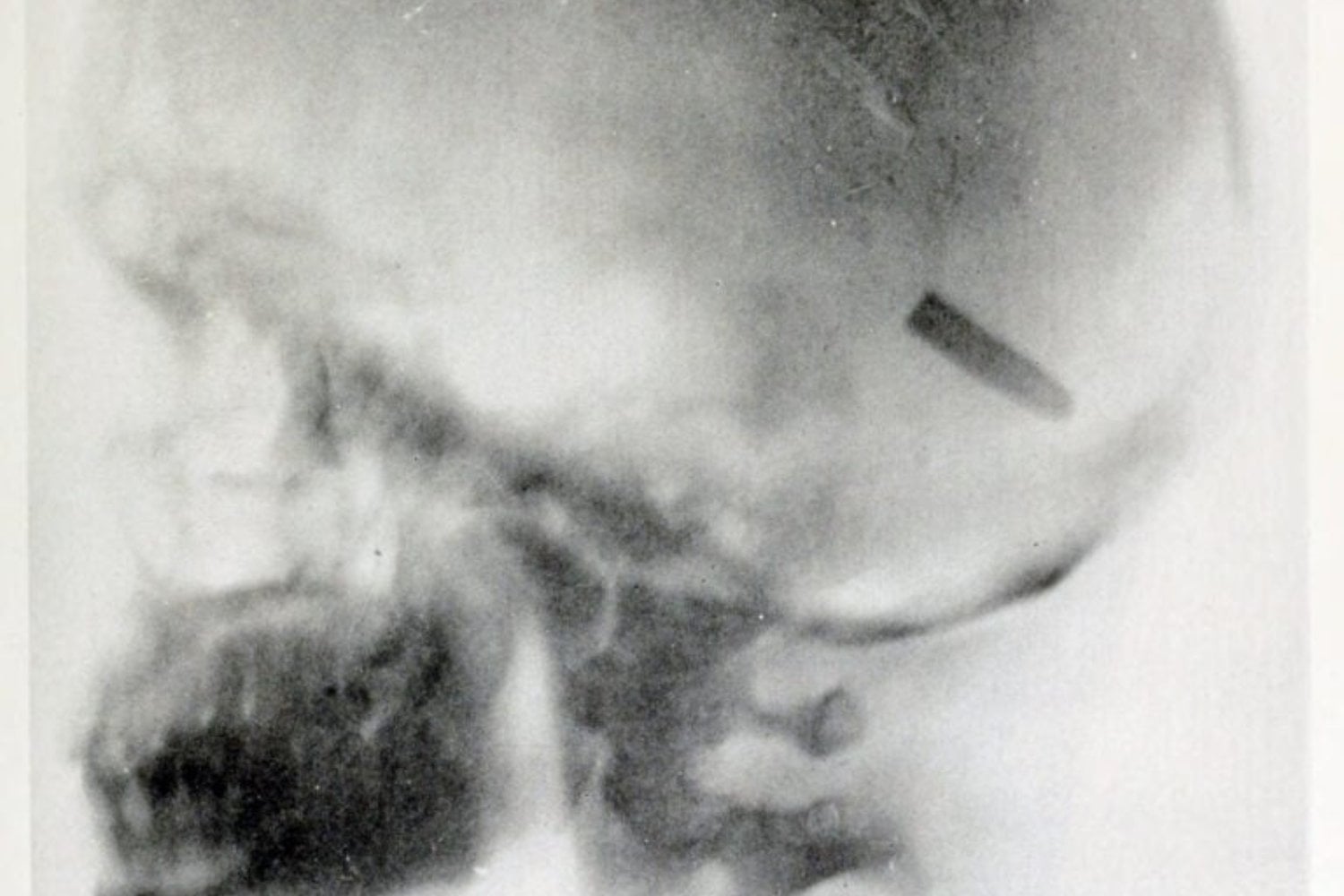 Radiografia De John Gretzer Jr Con Bala En El Cerebro