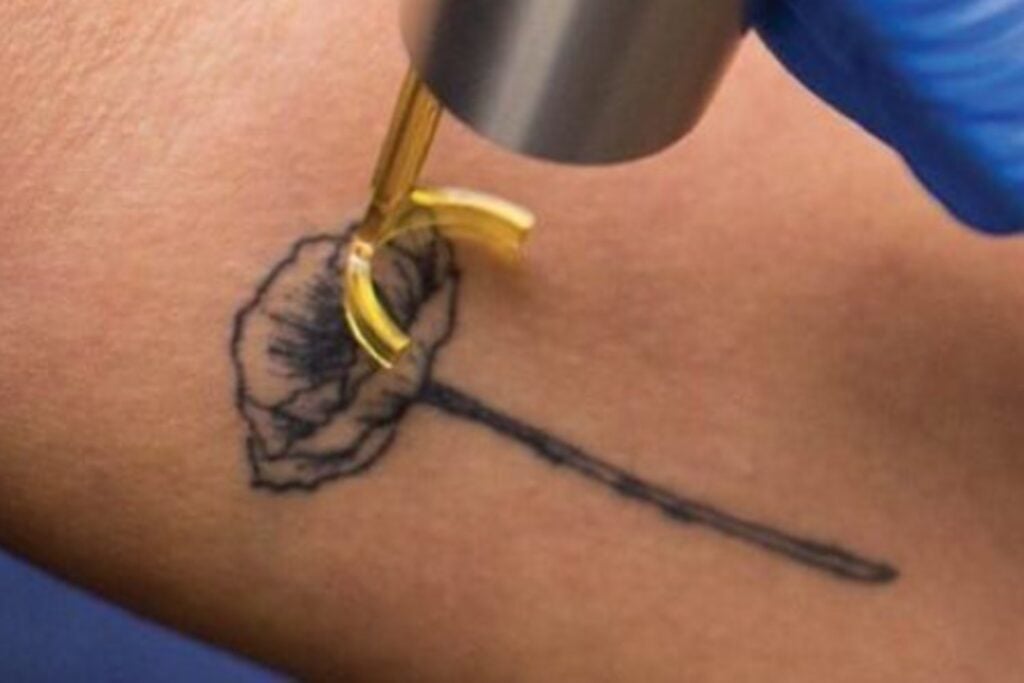 ¿Qué es más seguro para tu piel: borrar un tatuaje o cubrirlo con otro?