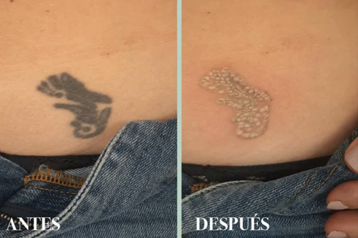 ¿Qué es más seguro para tu piel: borrar un tatuaje o cubrirlo con otro?