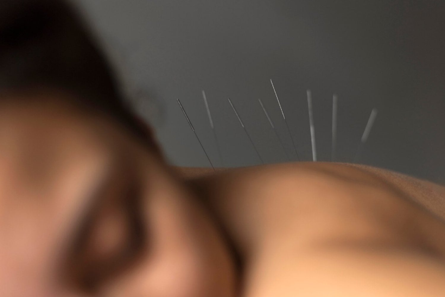 Oro bajo la piel: los riesgos silenciosos de la acupuntura permanente que preocupan a los médicos