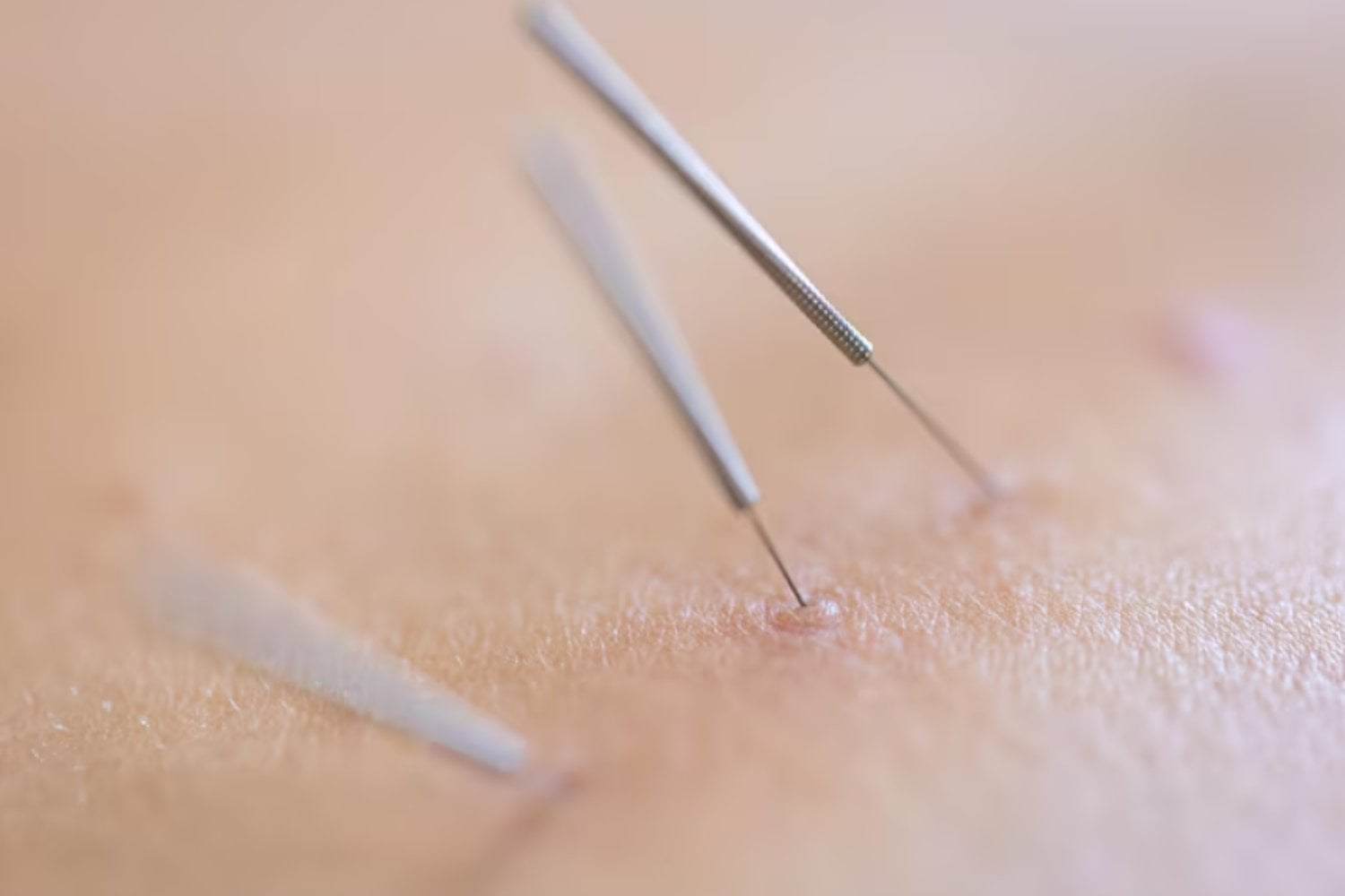 Oro bajo la piel: los riesgos silenciosos de la acupuntura permanente que preocupan a los médicos