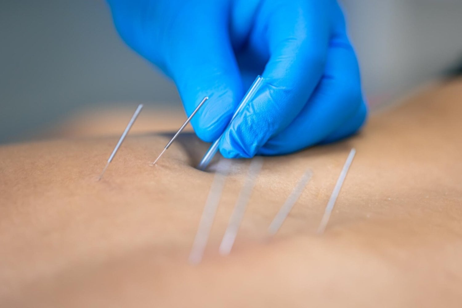 Oro bajo la piel: los riesgos silenciosos de la acupuntura permanente que preocupan a los médicos