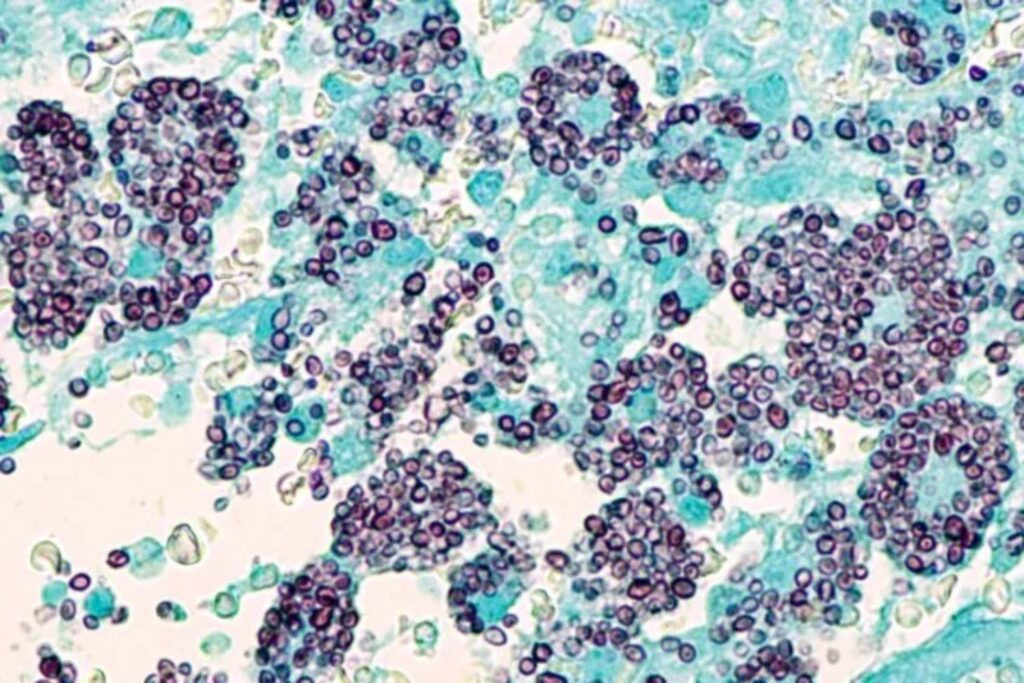 Histoplasmosis