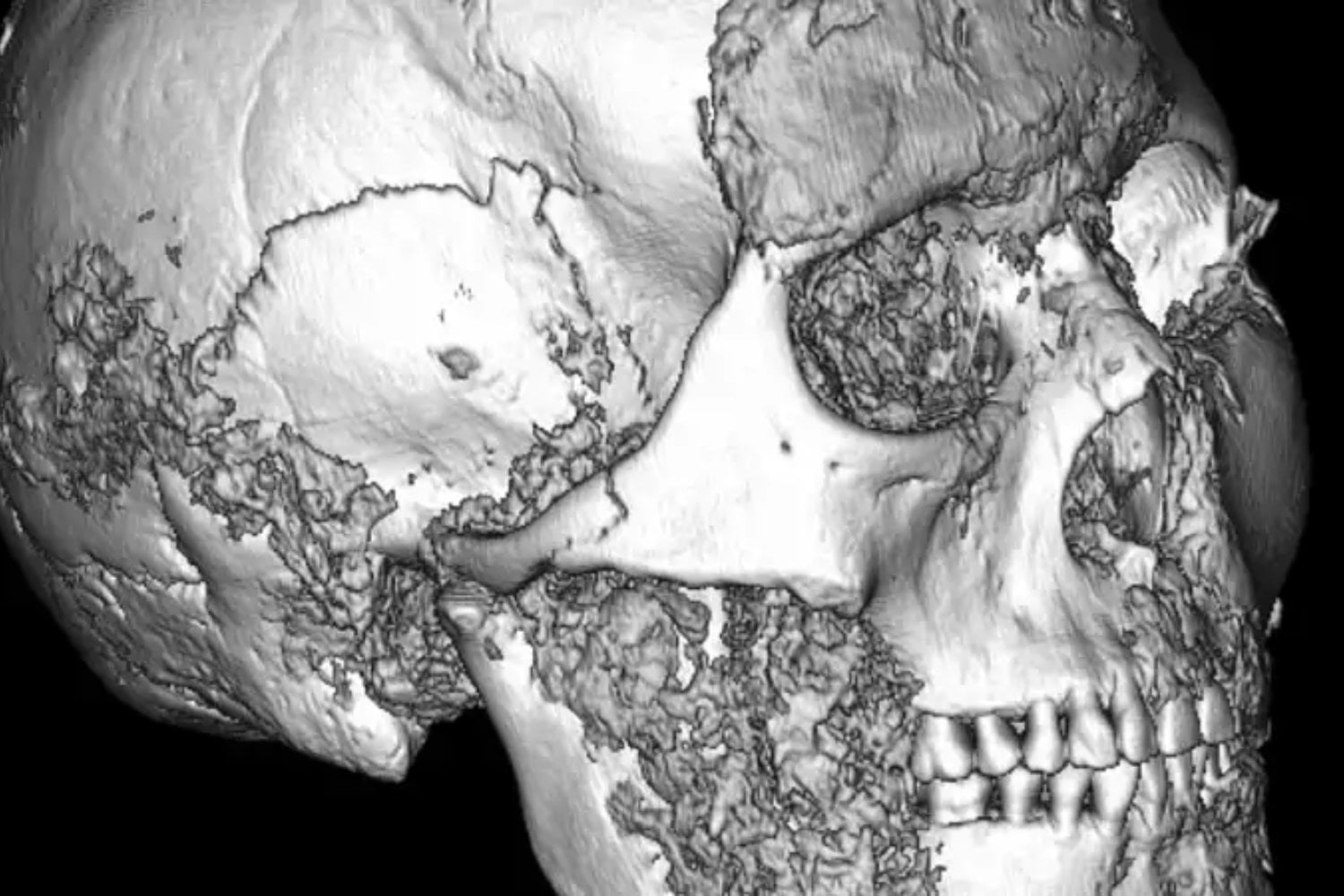 Hace 2.500 años alguien reconstruyó una mandíbula en Siberia. El cráneo que demuestra que la cirugía existía mucho antes de la medicina moderna