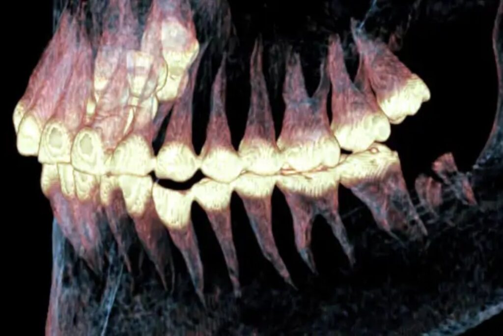 Hace 2.500 años alguien reconstruyó una mandíbula en Siberia. El cráneo que demuestra que la cirugía existía mucho antes de la medicina moderna
