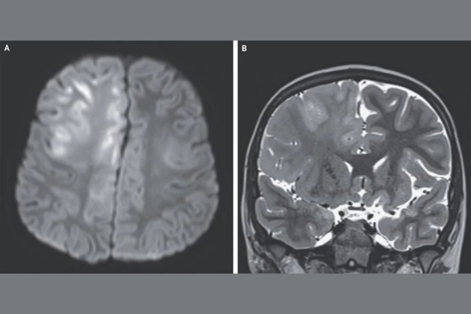 Cerebro Con Sarampion