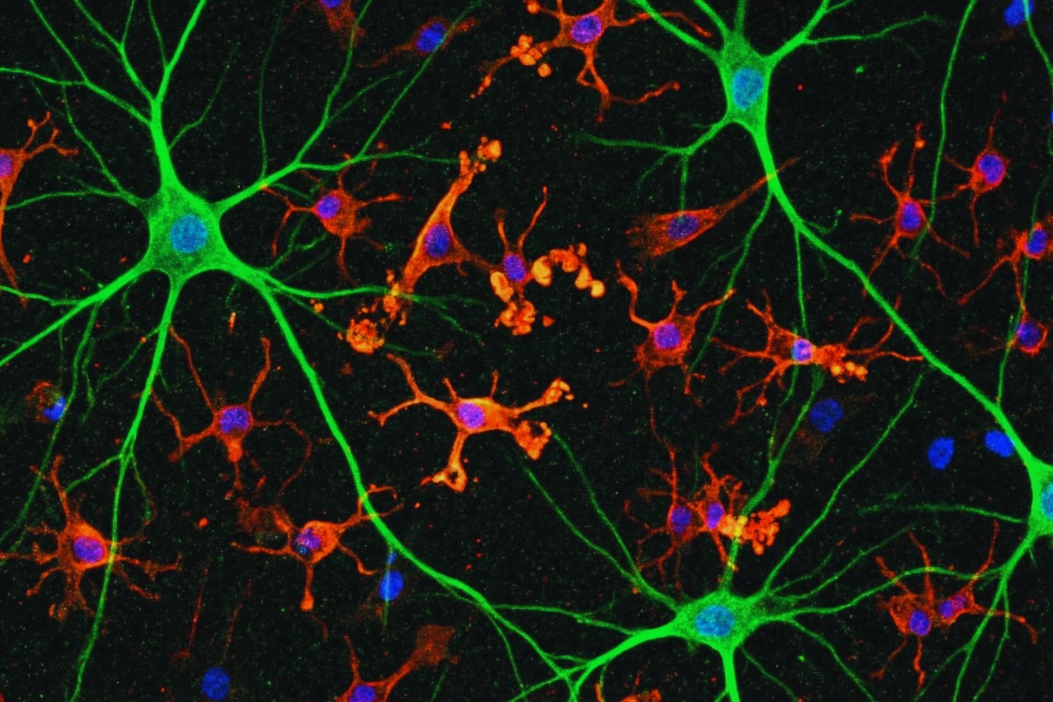 El Alzheimer podría no empezar donde creíamos y eso cambia todo lo que sabemos sobre la enfermedad. Un nuevo estudio revela que una “competencia” microscópica entre proteínas dentro de las neuronas podría ser el verdadero origen del deterioro cognitivo