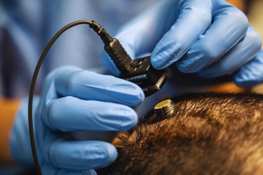 Mientras medio mundo sigue hipnotizado con la inteligencia artificial, China está empujando otra tecnología todavía más inquietante… La de los chips implantados directamente en el cerebro