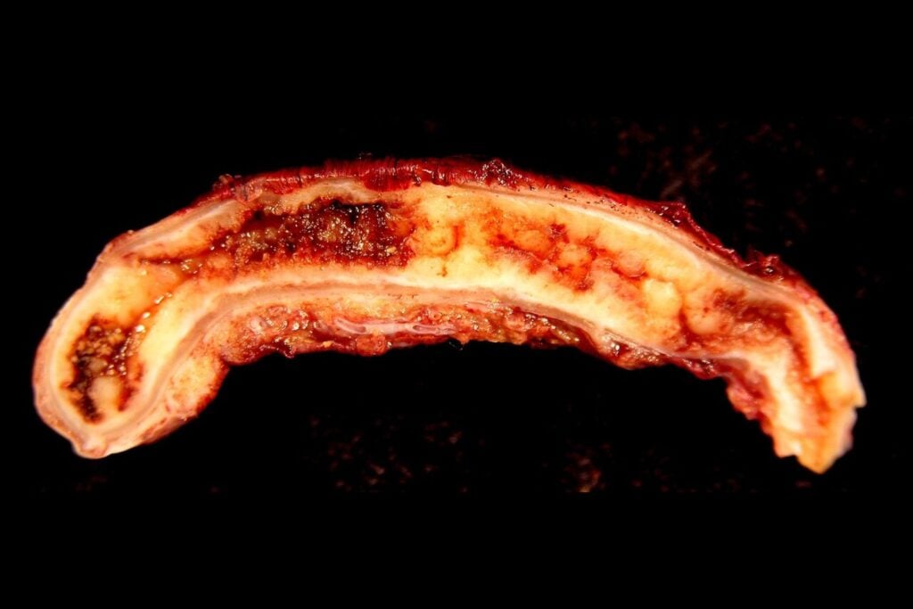 Durante décadas se enseñó que el apéndice era un órgano inútil heredado del pasado. La evolución lo ha “reinventado” más de 30 veces y eso está obligando a replantear lo que creíamos saber
