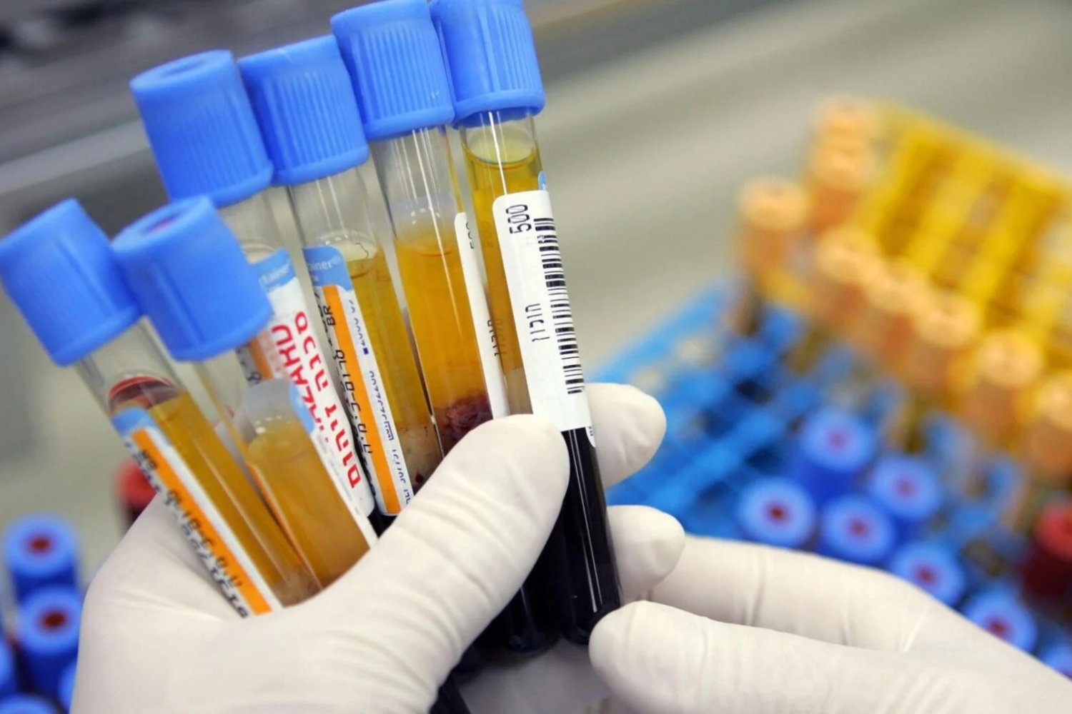 Analisis De Sangre