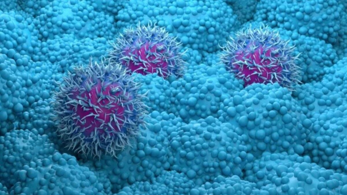 Cáncer de páncreas: Una nueva droga experimental mejora su tratamiento