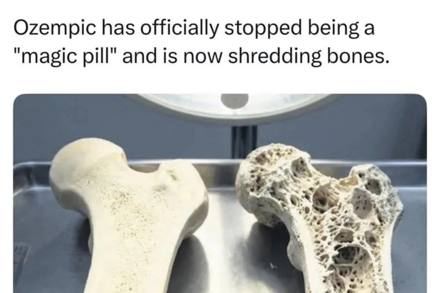 Ozempic Huesos