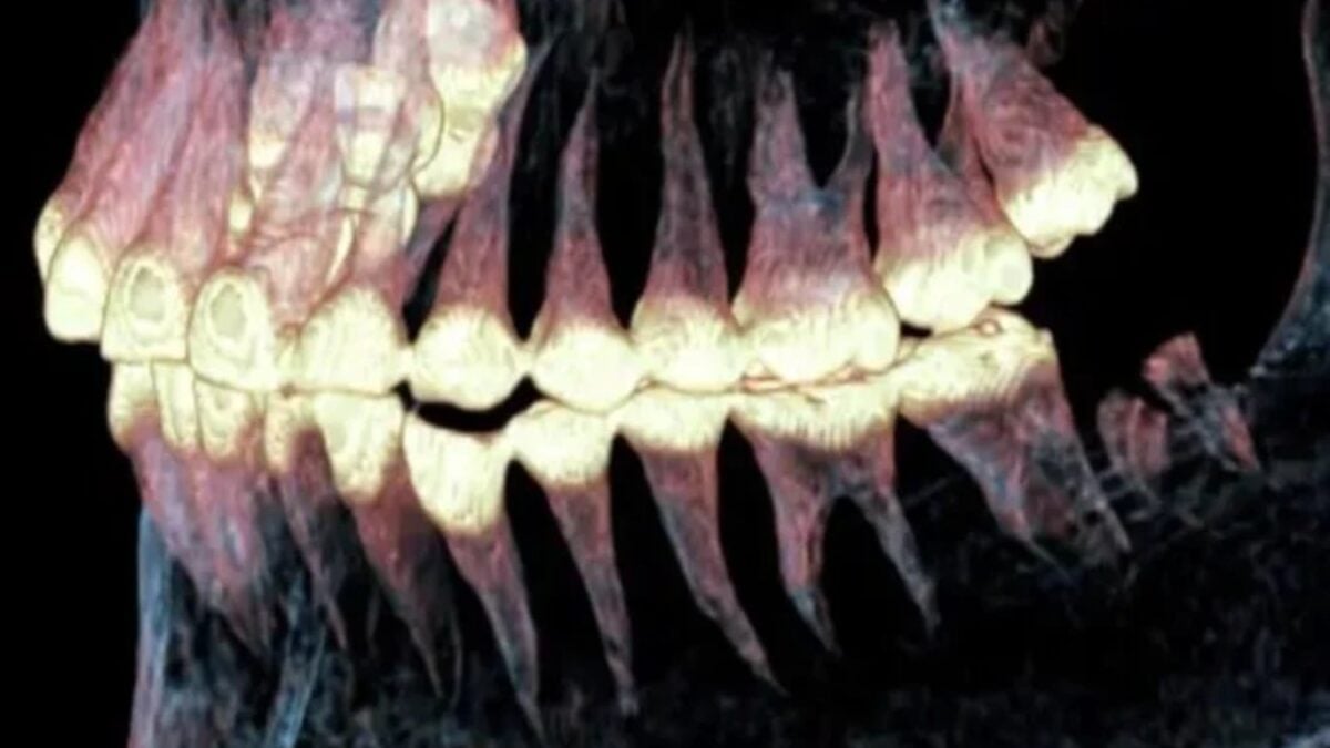 Arqueólogos encontraron 13 dientes fósiles que no pertenecen a ninguna especie humana conocida. El hallazgo podría revelar la existencia de un ancestro perdido que convivió con otros linajes hace más de dos millones de años