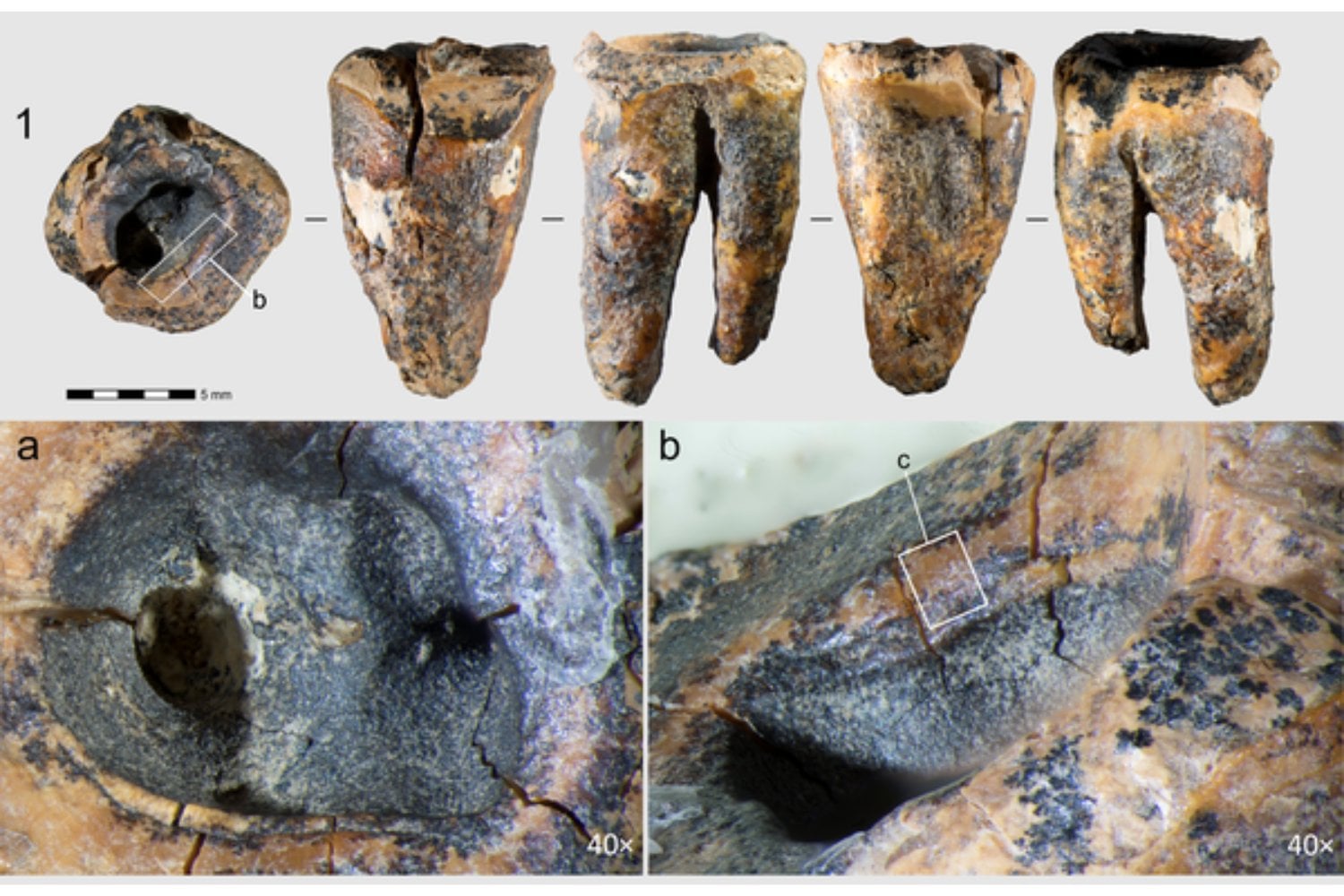 Un diente neandertal de hace 59.000 años hallado en Siberia acaba de cambiar la historia de la medicina humana. Todo indica que alguien perforó una caries con herramientas de piedra para aliviar un dolor insoportable