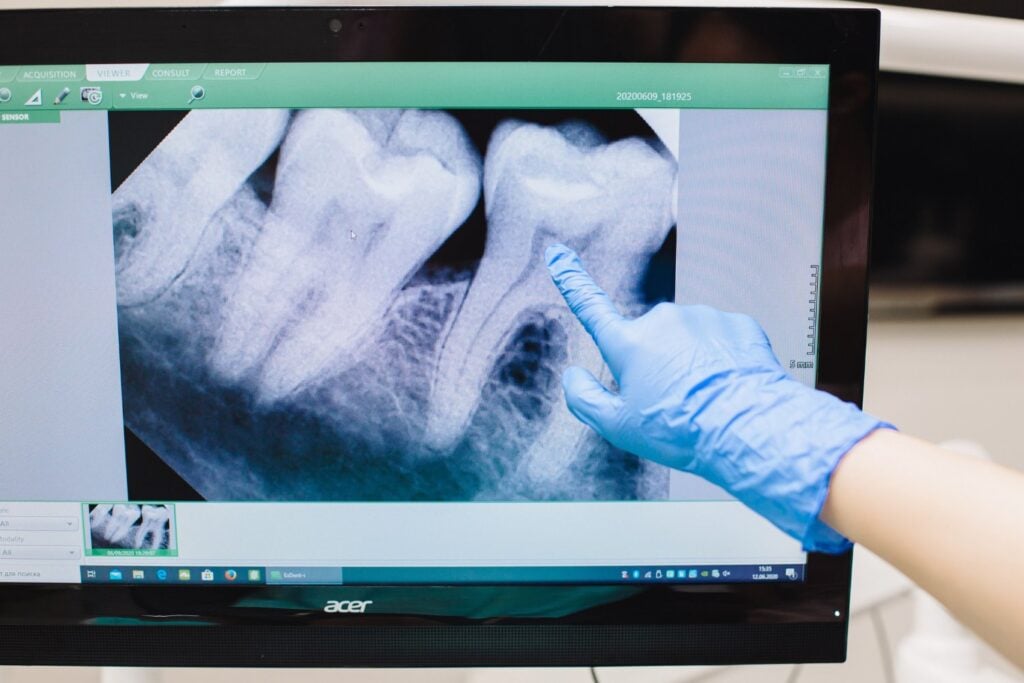 La odontología se prepara para su salto robótico: un minirobot ya puede tallar dientes con precisión milimétrica