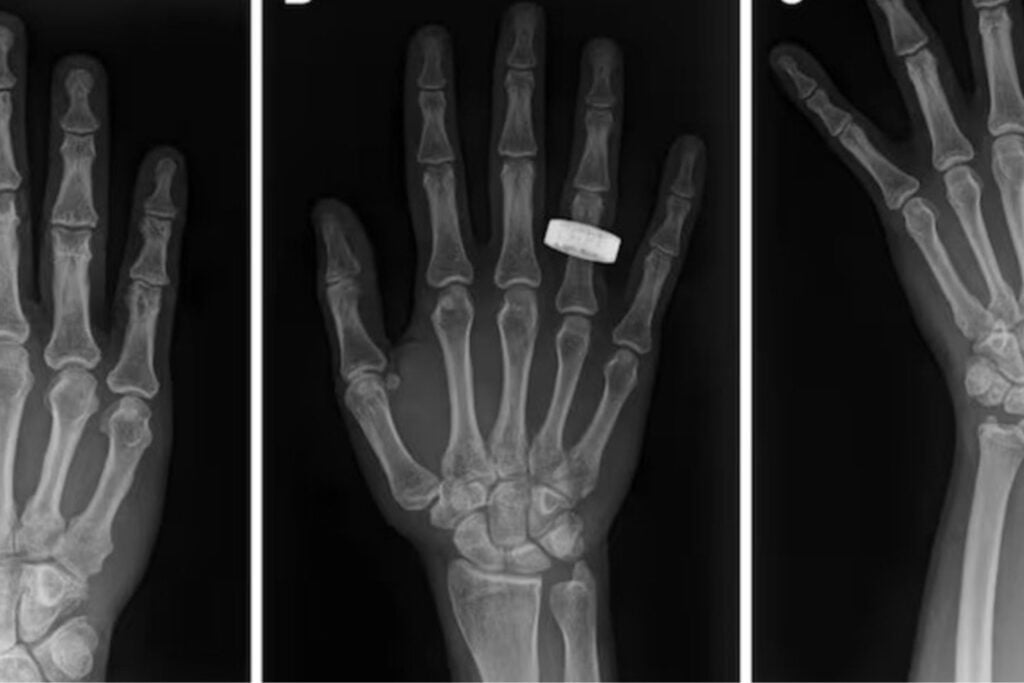 Una tripulación sin médicos logra las primeras radiografías humanas en órbita con solo cuatro horas de entrenamiento. El experimento abre la puerta a diagnosticar fracturas durante futuras misiones a la Luna