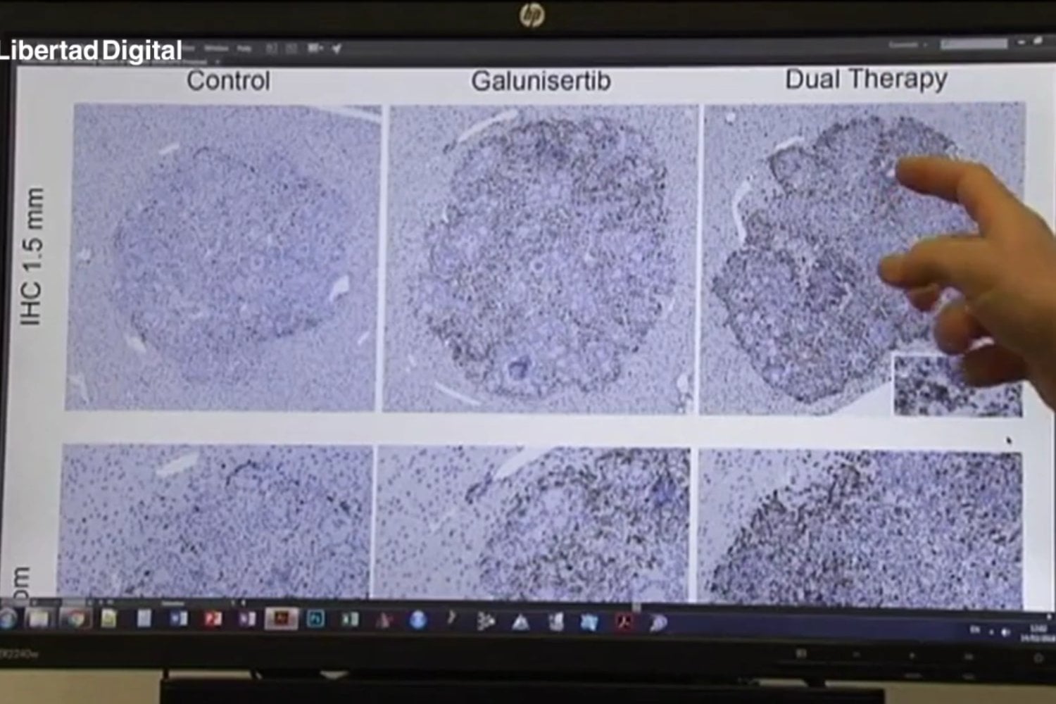 Científicos crean una técnica capaz de seguir el cáncer desde todo el cuerpo hasta una sola célula
