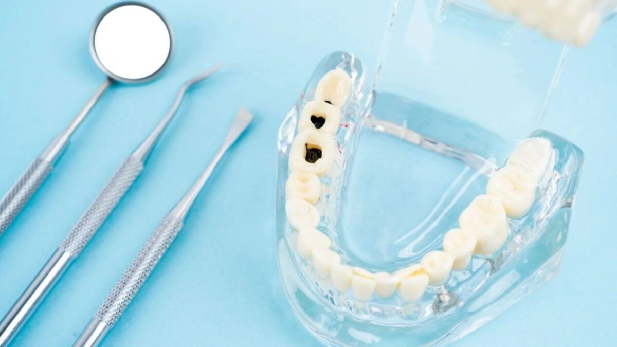 Adiós al torno del dentista: Un líquido con flúor podría detener las caries sin necesidad de perforar los dientes