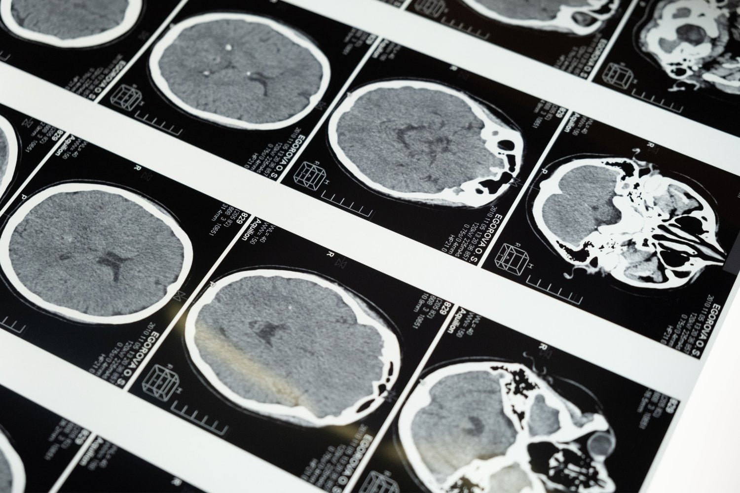 Varias vacunas se asocian con un menor riesgo de demencia. La ciencia cree que podría haber una razón inesperada